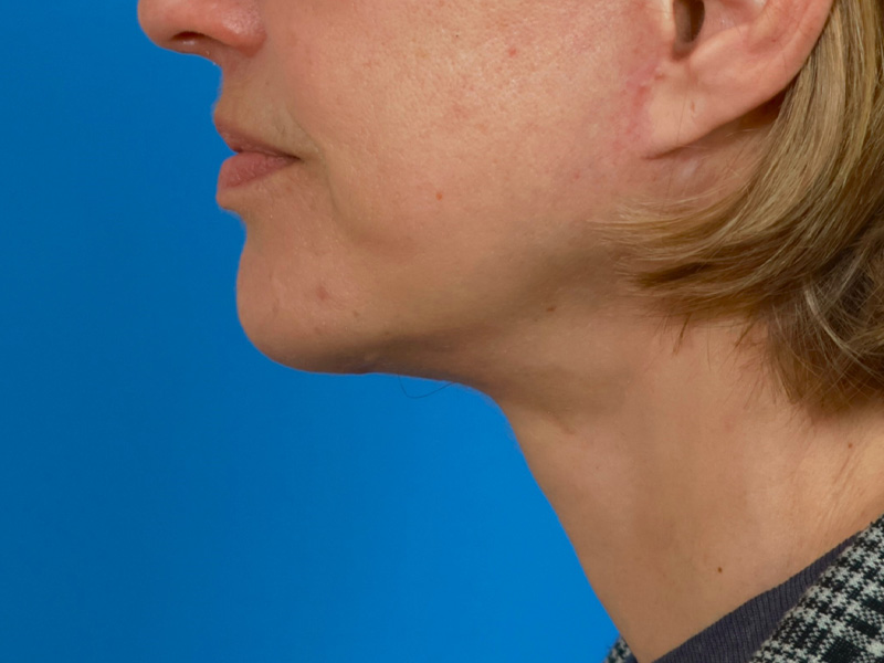 Chin & Jawline Before & After Image