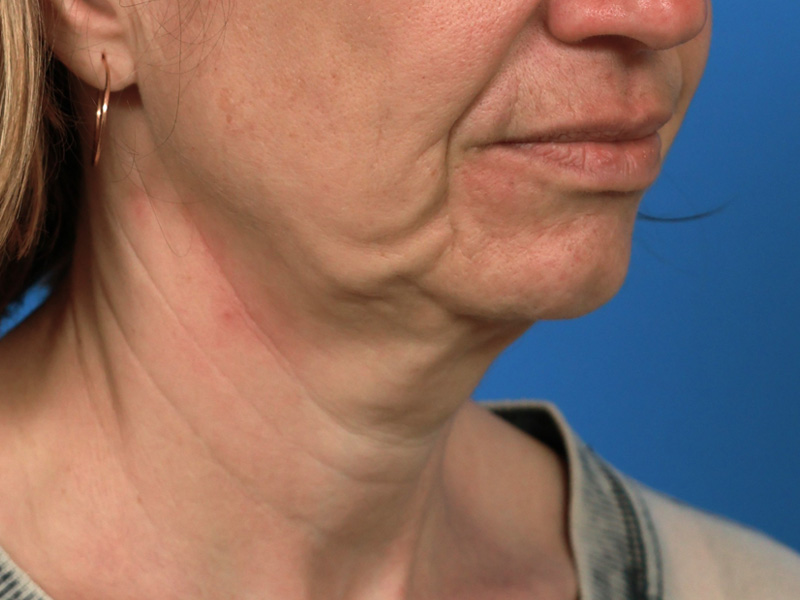 Chin & Jawline Before & After Image