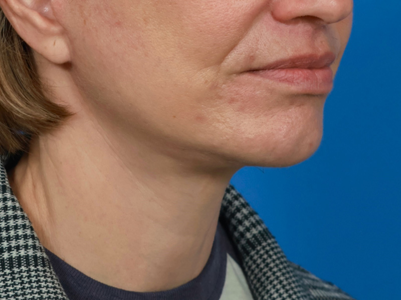 Chin & Jawline Before & After Image