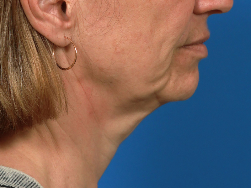 Chin & Jawline Before & After Image