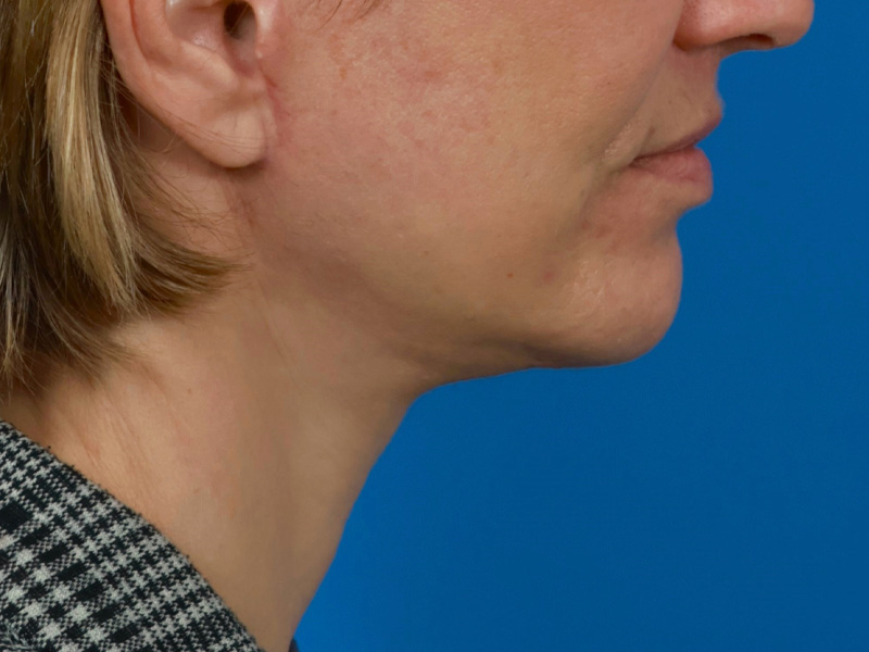 Chin & Jawline Before & After Image