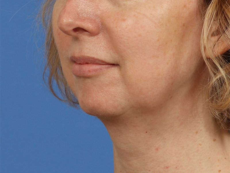 Chin & Jawline Before & After Image