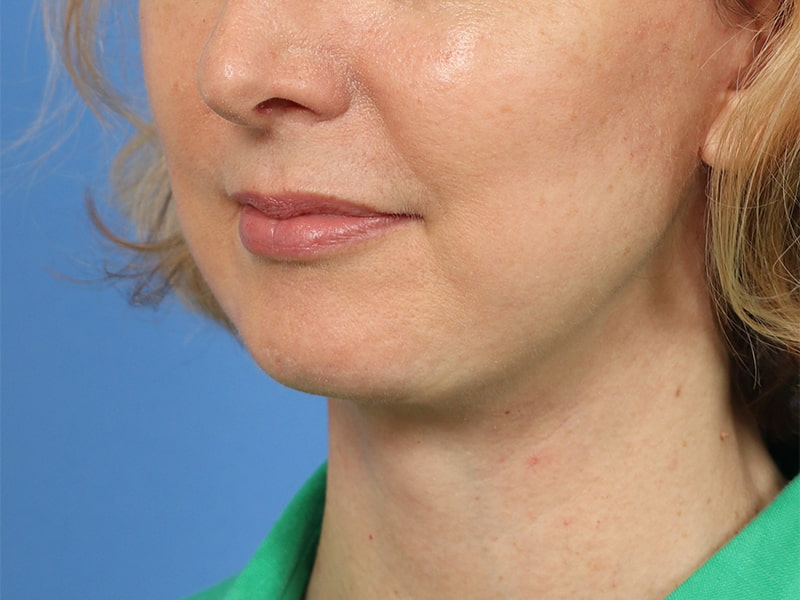 Chin & Jawline Before & After Image