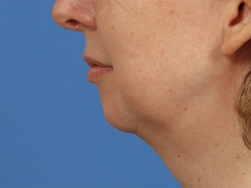 Chin & Jawline Before & After Image