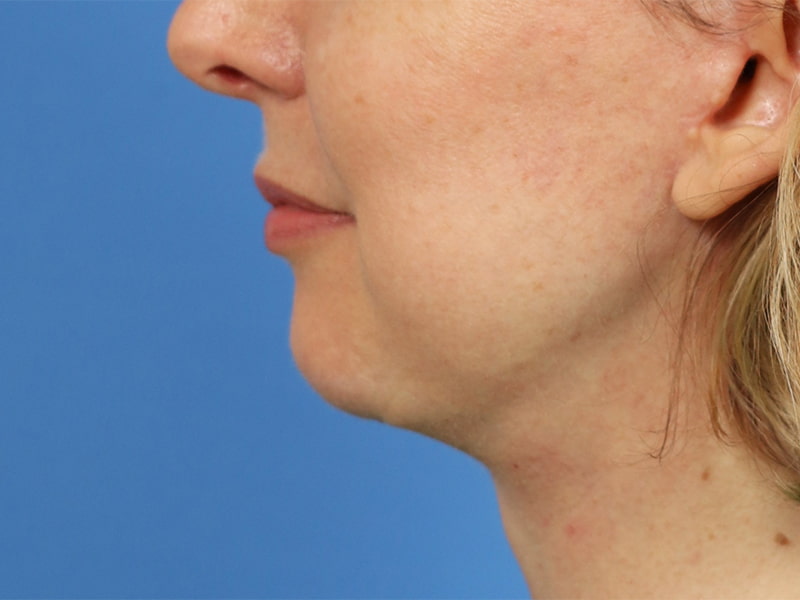 Chin & Jawline Before & After Image