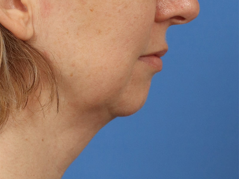 Chin & Jawline Before & After Image