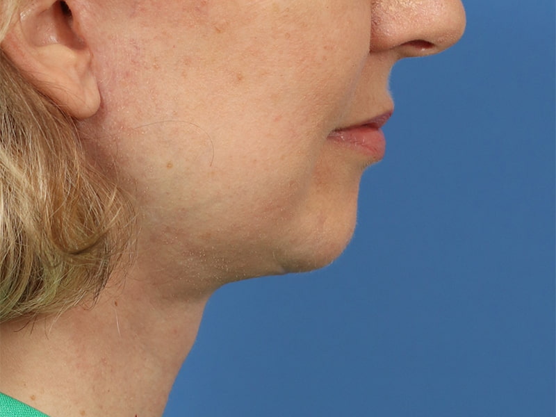 Chin & Jawline Before & After Image