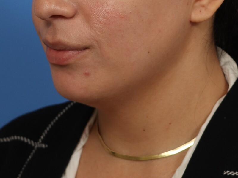 Chin & Jawline Before & After Image