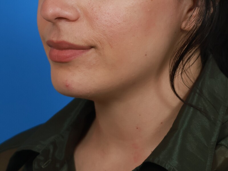 Chin & Jawline Before & After Image