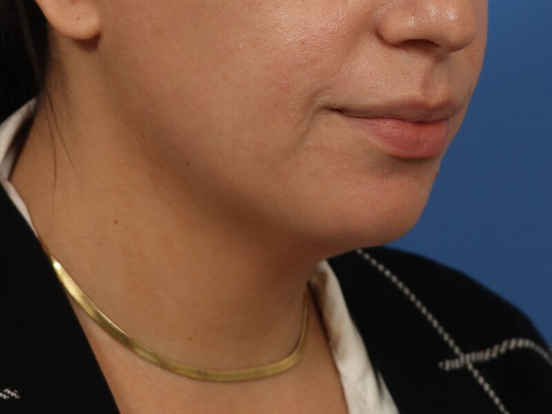 Chin & Jawline Before & After Image
