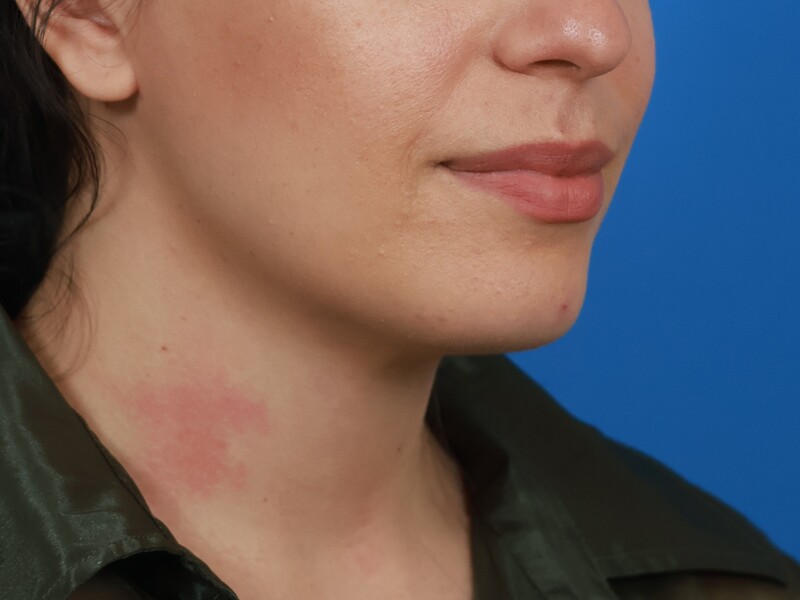 Chin & Jawline Before & After Image