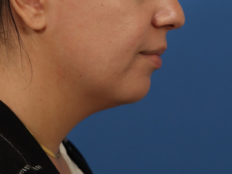 Chin & Jawline Before & After Image