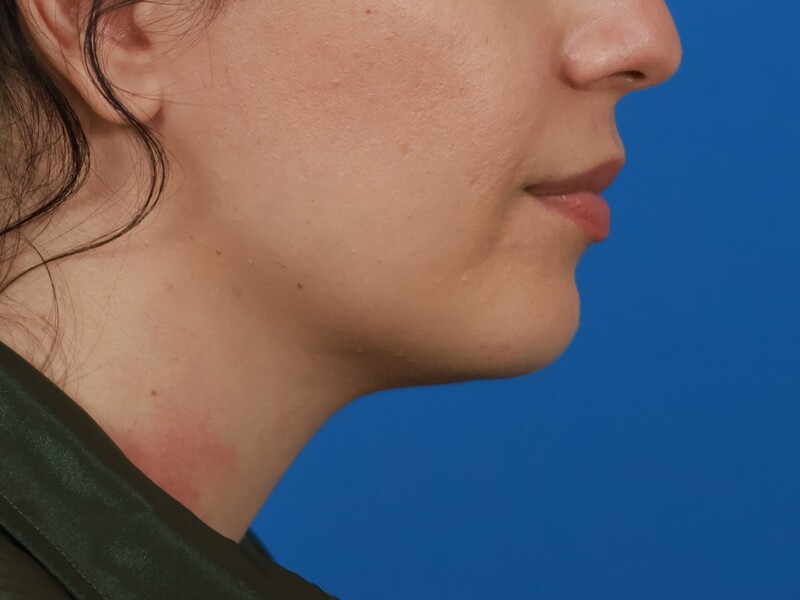 Chin & Jawline Before & After Image