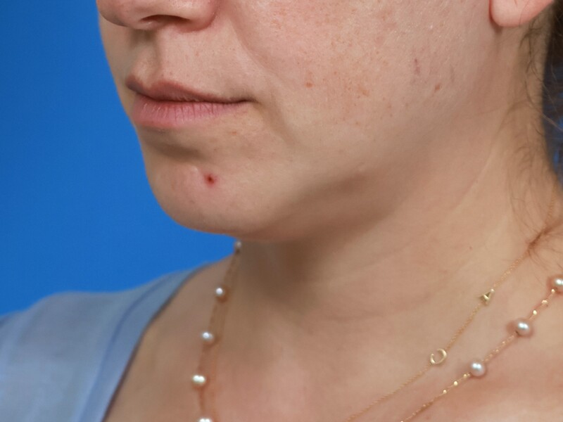 Chin & Jawline Before & After Image