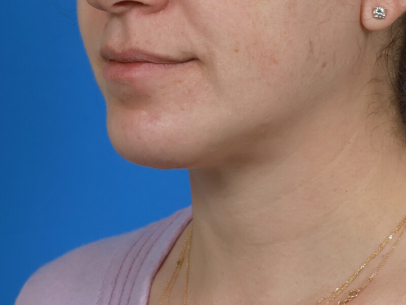 Chin & Jawline Before & After Image