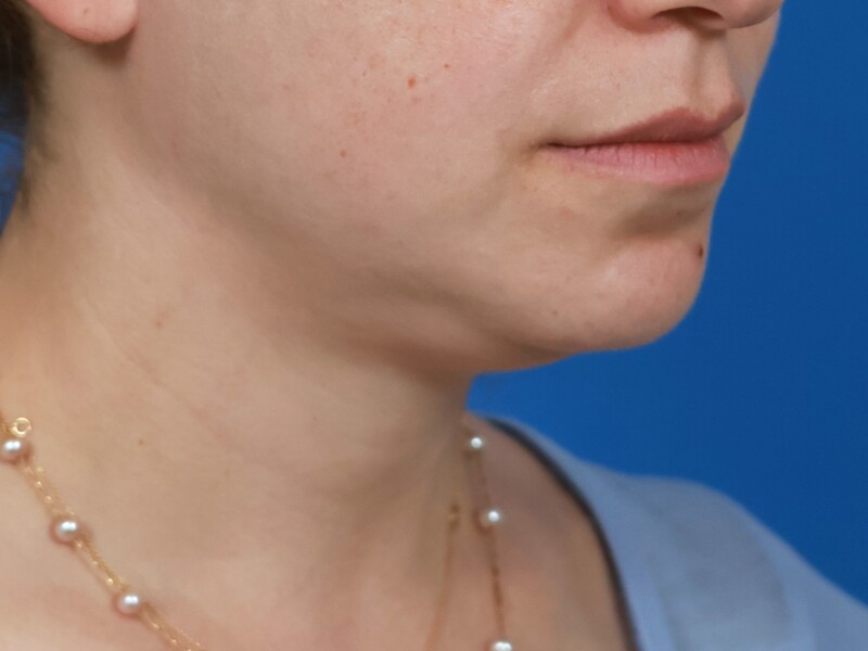 Chin & Jawline Before & After Image