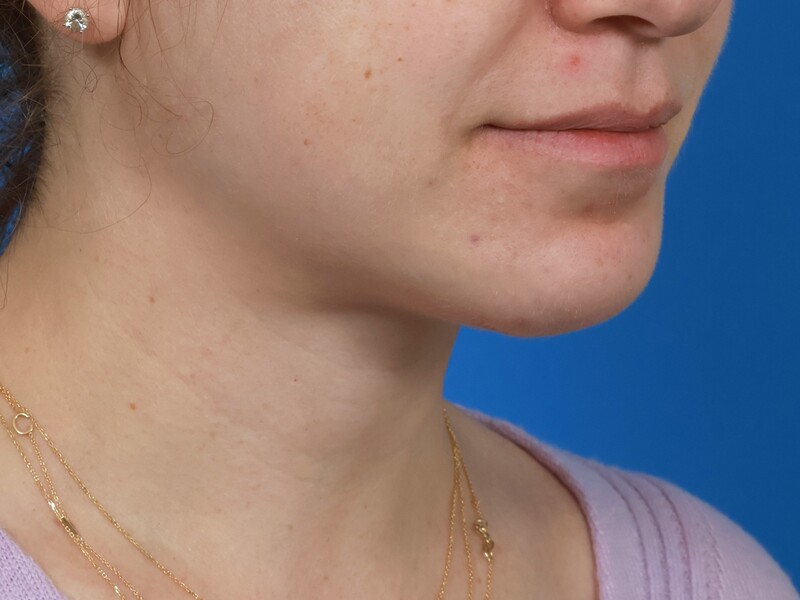 Chin & Jawline Before & After Image