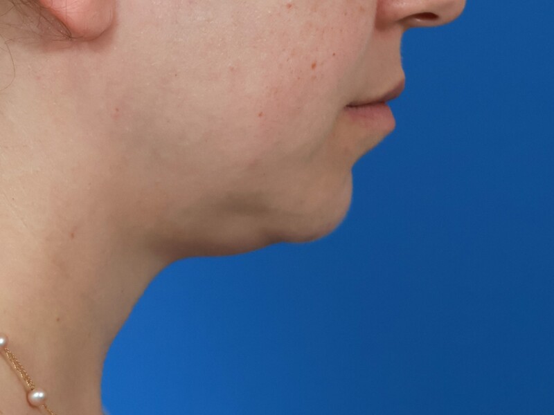 Chin & Jawline Before & After Image