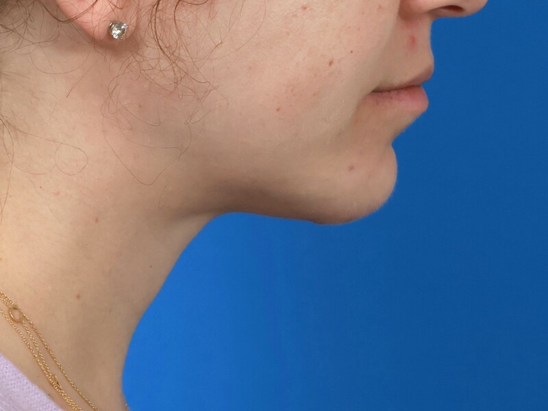 Chin & Jawline Before & After Image