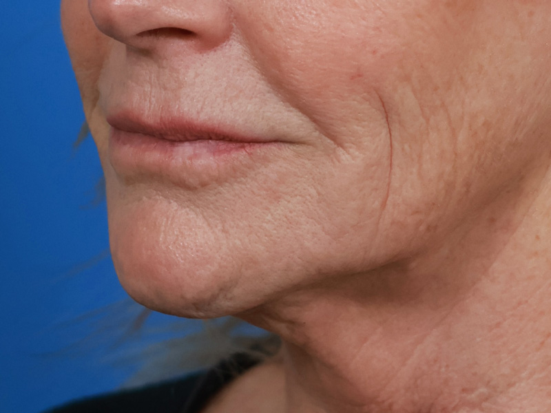 Chin & Jawline Before & After Image
