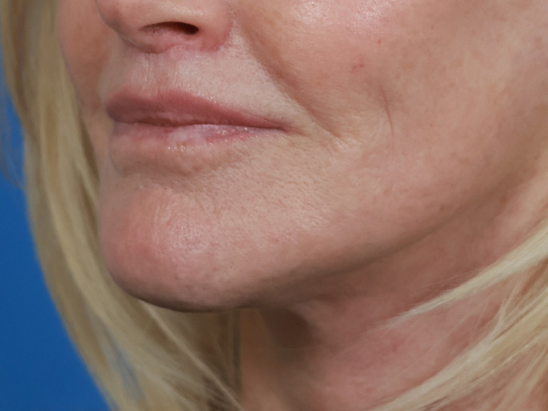Chin & Jawline Before & After Image
