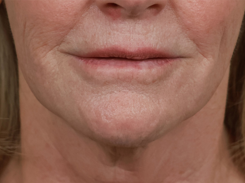 Chin & Jawline Before & After Image