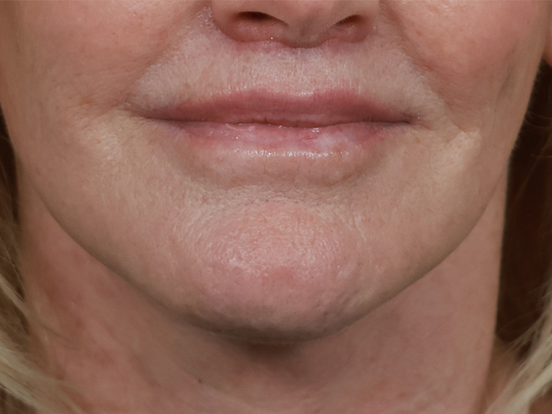 Chin & Jawline Before & After Image