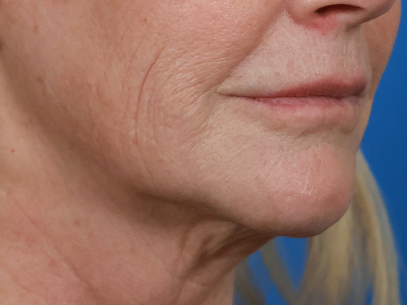Chin & Jawline Before & After Image