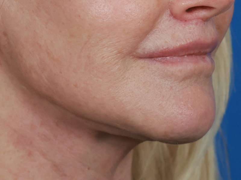 Chin & Jawline Before & After Image