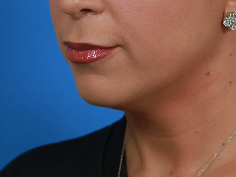 Chin & Jawline Before & After Image