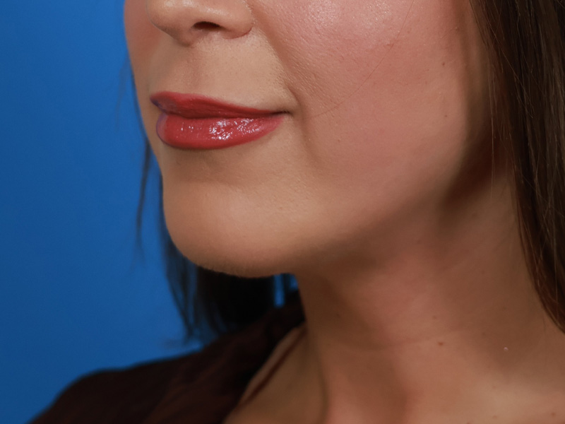 Chin & Jawline Before & After Image
