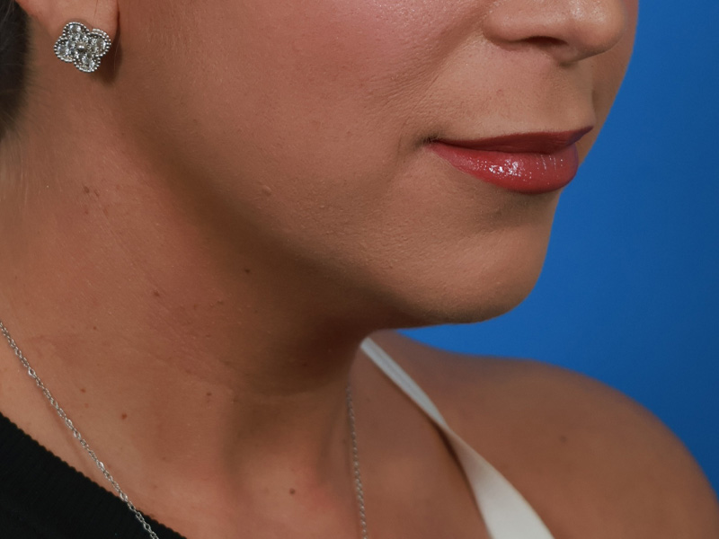 Chin & Jawline Before & After Image