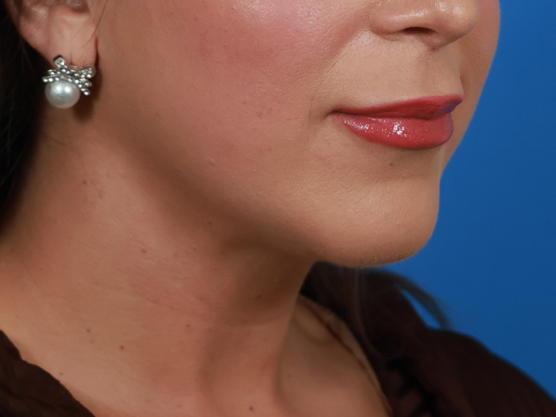 Chin & Jawline Before & After Image