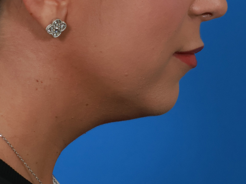 Chin & Jawline Before & After Image
