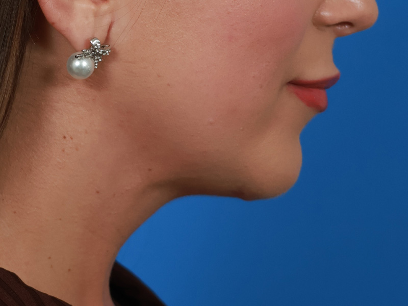 Chin & Jawline Before & After Image