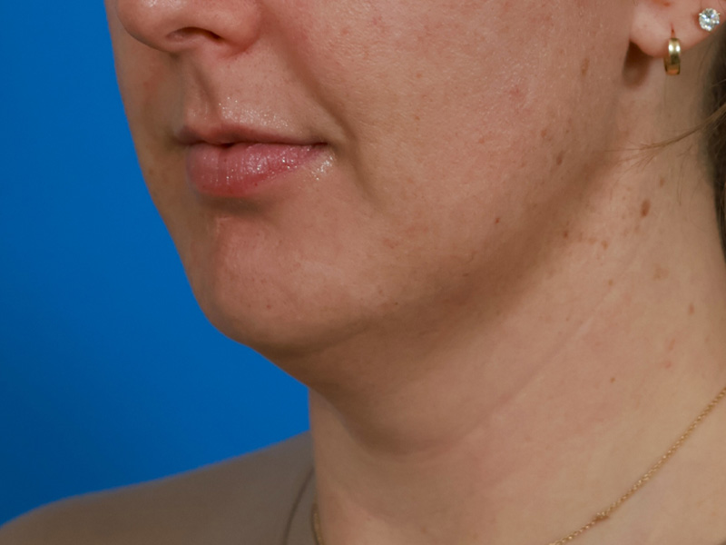 Chin & Jawline Before & After Image