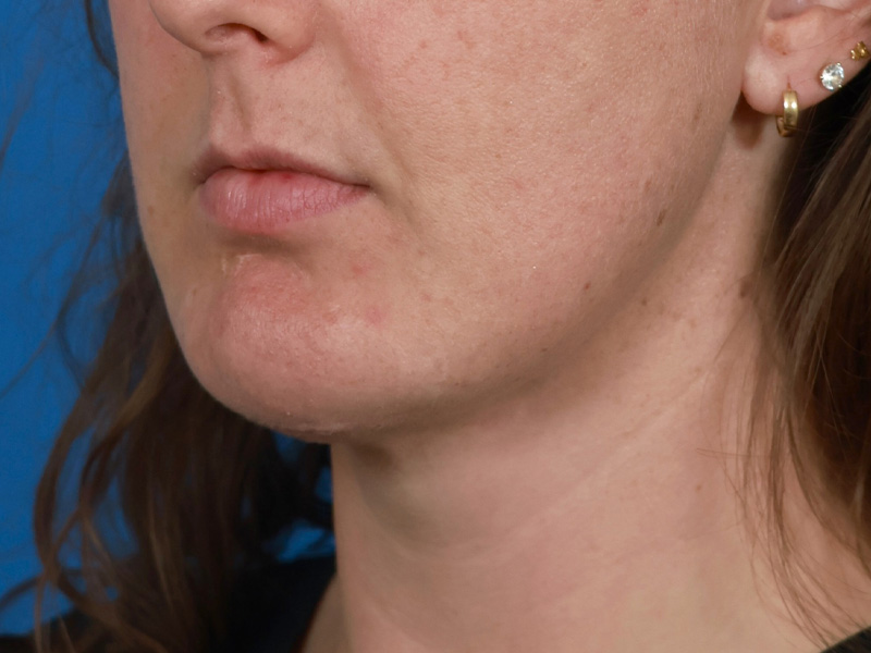 Chin & Jawline Before & After Image