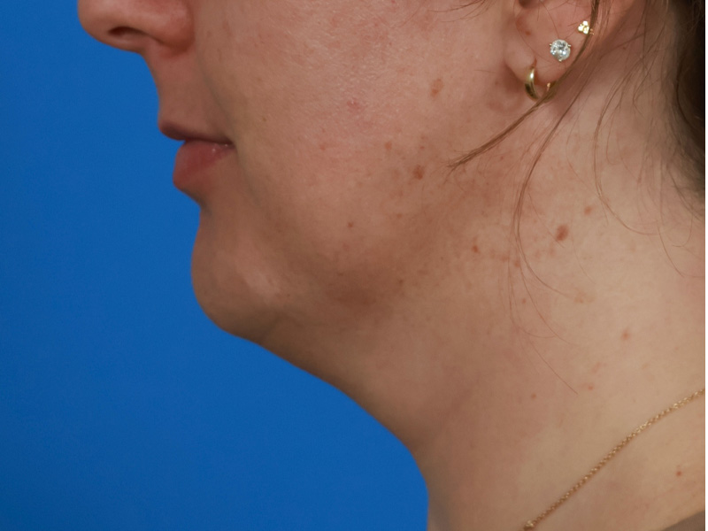 Chin & Jawline Before & After Image