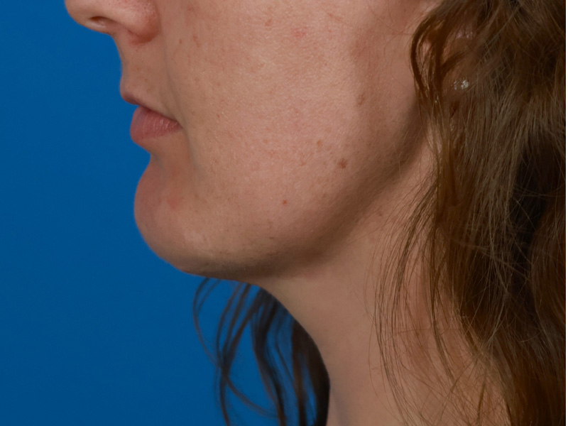 Chin & Jawline Before & After Image