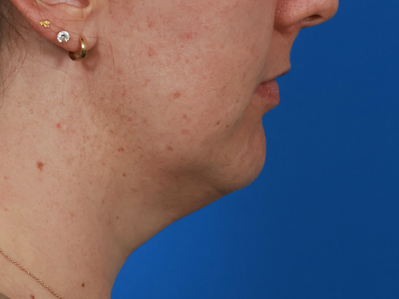 Chin & Jawline Before & After Image