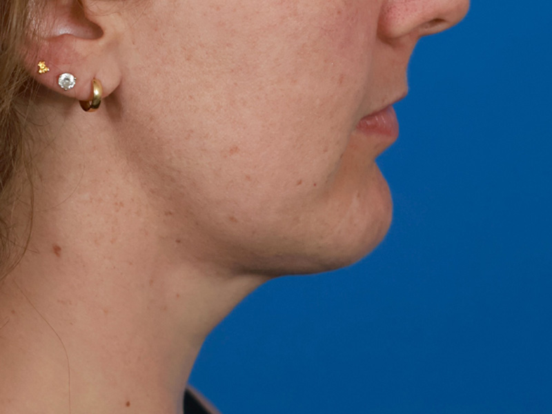 Chin & Jawline Before & After Image