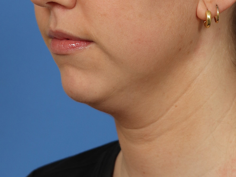 Chin & Jawline Before & After Image