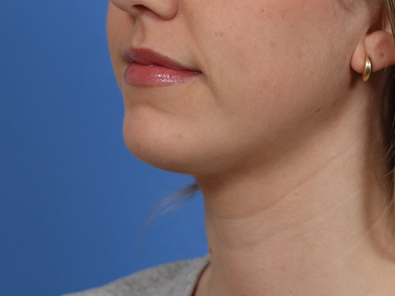 Chin & Jawline Before & After Image