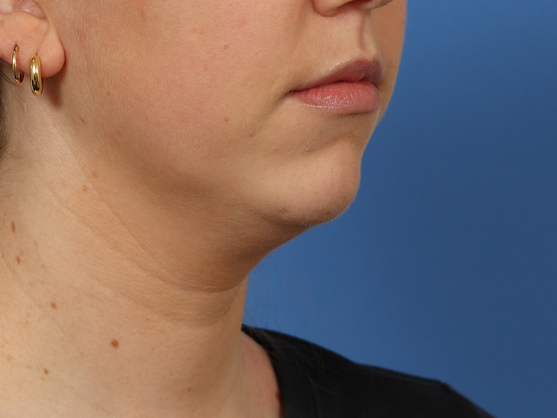 Chin & Jawline Before & After Image