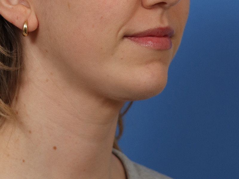 Chin & Jawline Before & After Image