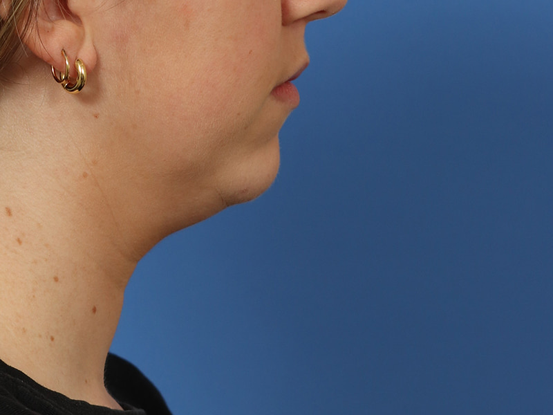 Chin & Jawline Before & After Image
