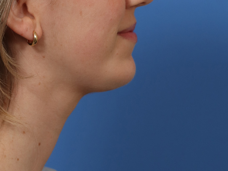 Chin & Jawline Before & After Image