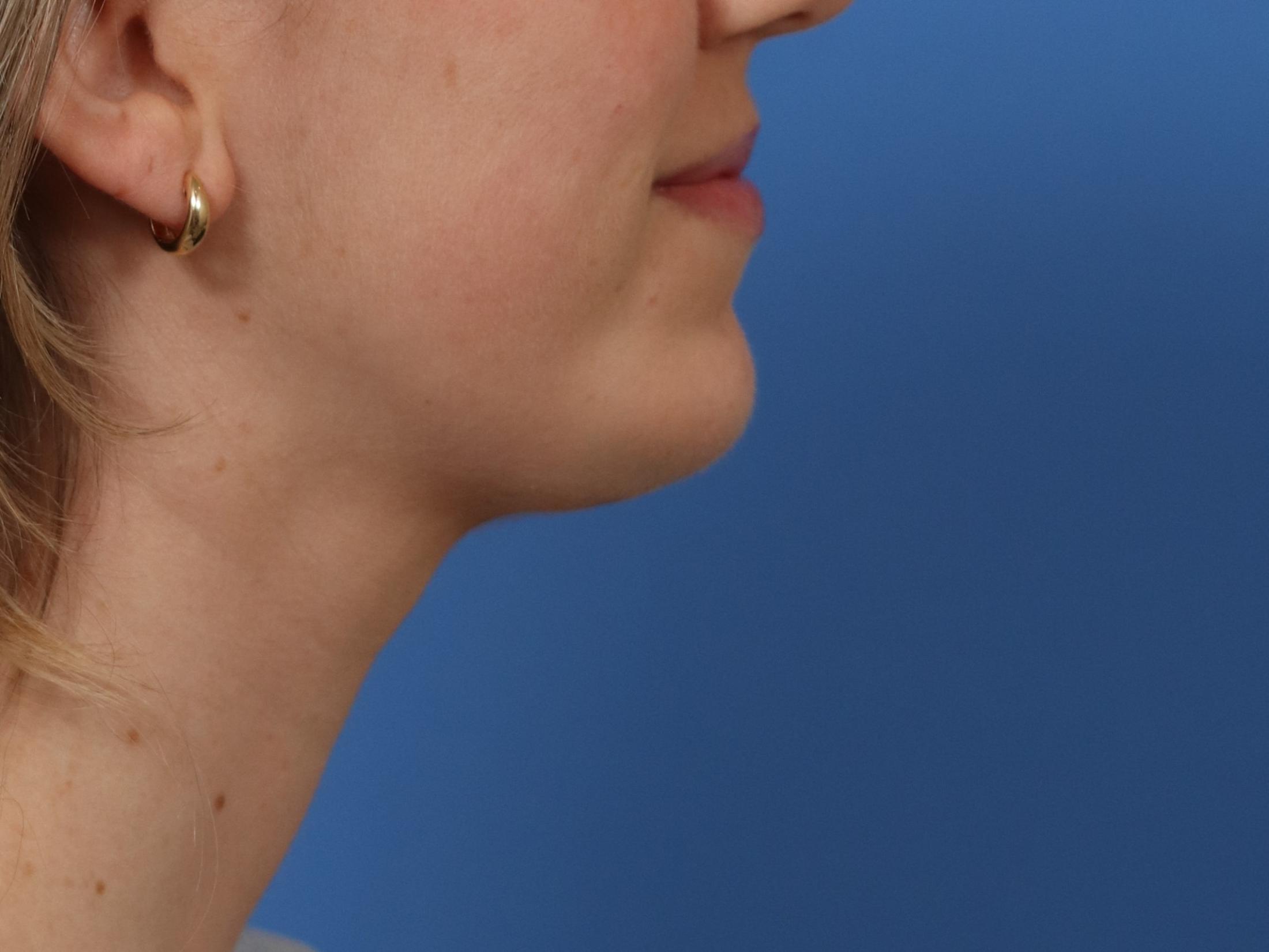 Chin Enhancement Before & After Image