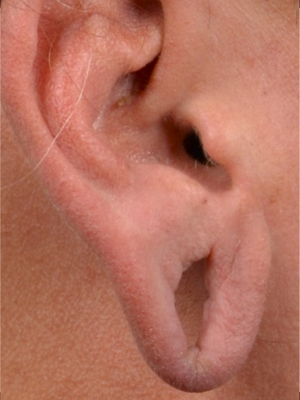 Earlobe Surgery Before & After Image