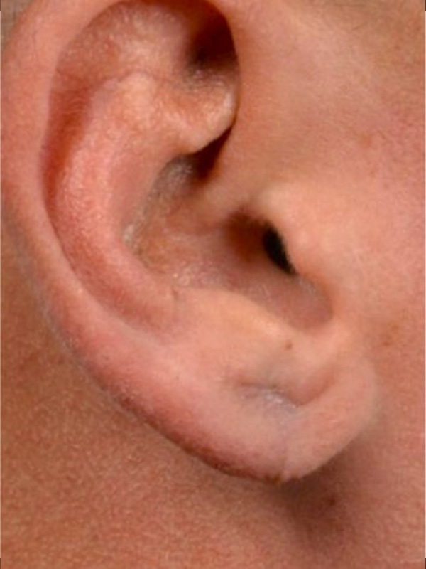 Earlobe Surgery Before & After Image